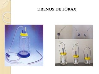 DRENOS DE TÓRAX
 