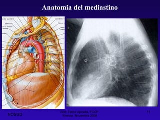 Dott. Felice Apicella, FCCP  Firenze, Novembre 2008 Anatomia del mediastino NOSGD 