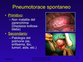Pneumotorace spontaneo Primitivo : Non malattie del parenchima (Displasia bollosa-blebs) Secondario : Patologia del polmone (es. enfisema, tbc, tumori, aids, etc.) Dott. Felice Apicella, FCCP  Firenze, Novembre 2008 NOSGD 
