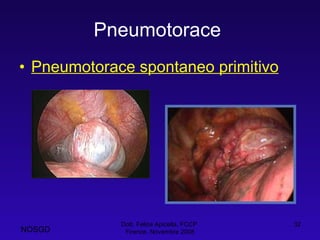 Pneumotorace   Pneumotorace spontaneo primitivo Dott. Felice Apicella, FCCP  Firenze, Novembre 2008 NOSGD 