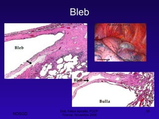 Bleb Dott. Felice Apicella, FCCP  Firenze, Novembre 2008 NOSGD 