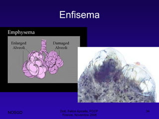 Enfisema Dott. Felice Apicella, FCCP  Firenze, Novembre 2008 NOSGD 