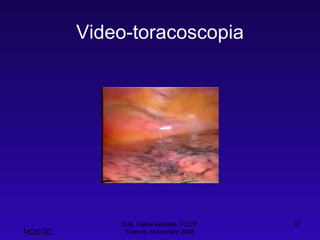 Video-toracoscopia Dott. Felice Apicella, FCCP  Firenze, Novembre 2008 NOSGD 