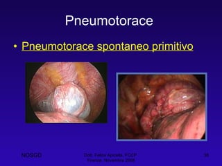 Pneumotorace   Pneumotorace spontaneo primitivo Dott. Felice Apicella, FCCP  Firenze, Novembre 2008 NOSGD 