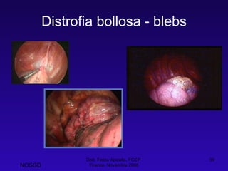Distrofia bollosa - blebs Dott. Felice Apicella, FCCP  Firenze, Novembre 2008 NOSGD 