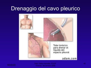 Drenaggio del cavo pleurico Dott. Felice Apicella, FCCP  Firenze, Novembre 2008 NOSGD 