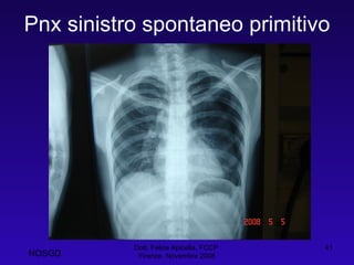 Pnx sinistro spontaneo primitivo Dott. Felice Apicella, FCCP  Firenze, Novembre 2008 NOSGD 
