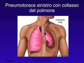 Pneumotorace sinistro con collasso del polmone Dott. Felice Apicella, FCCP  Firenze, Novembre 2008 NOSGD 
