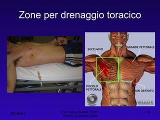 Zone per drenaggio toracico Dott. Felice Apicella, FCCP  Firenze, Novembre 2008 NOSGD 