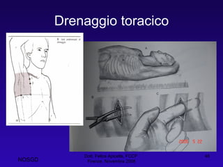 Drenaggio toracico Dott. Felice Apicella, FCCP  Firenze, Novembre 2008 NOSGD 
