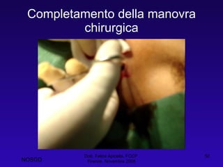 Completamento della manovra chirurgica Dott. Felice Apicella, FCCP  Firenze, Novembre 2008 NOSGD 
