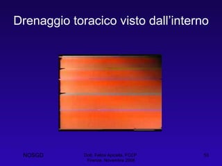 Drenaggio toracico visto dall’interno Dott. Felice Apicella, FCCP  Firenze, Novembre 2008 NOSGD 