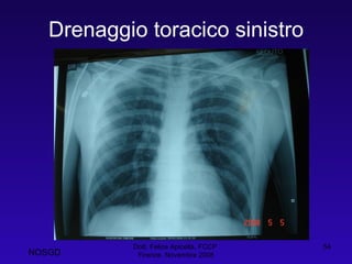 Drenaggio toracico sinistro Dott. Felice Apicella, FCCP  Firenze, Novembre 2008 NOSGD 