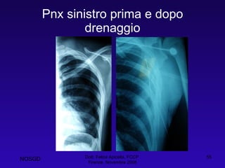 Pnx sinistro prima e dopo drenaggio Dott. Felice Apicella, FCCP  Firenze, Novembre 2008 NOSGD 