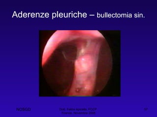 Aderenze pleuriche –  bullectomia sin. Dott. Felice Apicella, FCCP  Firenze, Novembre 2008 NOSGD 