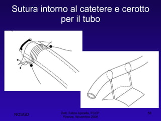 Sutura intorno al catetere e cerotto per il tubo Dott. Felice Apicella, FCCP  Firenze, Novembre 2008 NOSGD 