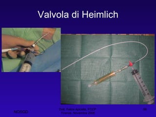 Valvola di Heimlich Dott. Felice Apicella, FCCP  Firenze, Novembre 2008 NOSGD 