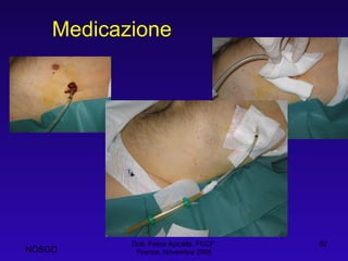 Medicazione Dott. Felice Apicella, FCCP  Firenze, Novembre 2008 NOSGD 