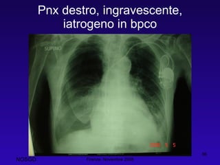 Pnx destro, ingravescente, iatrogeno in bpco Dott. Felice Apicella, FCCP  Firenze, Novembre 2008 NOSGD 