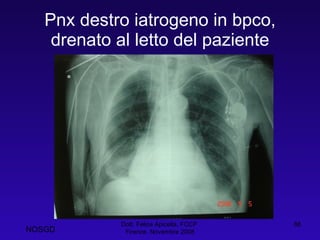 Pnx destro iatrogeno in bpco, drenato al letto del paziente Dott. Felice Apicella, FCCP  Firenze, Novembre 2008 NOSGD 