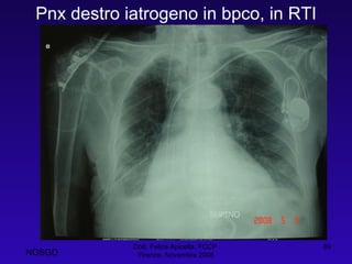Pnx destro iatrogeno in bpco, in RTI Dott. Felice Apicella, FCCP  Firenze, Novembre 2008 NOSGD 