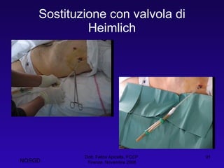 Sostituzione con valvola di Heimlich Dott. Felice Apicella, FCCP  Firenze, Novembre 2008 NOSGD 