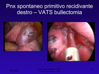 Pnx spontaneo primitivo recidivante destro – VATS bullectomia Dott. Felice Apicella, FCCP  Firenze, Novembre 2008 NOSGD 
