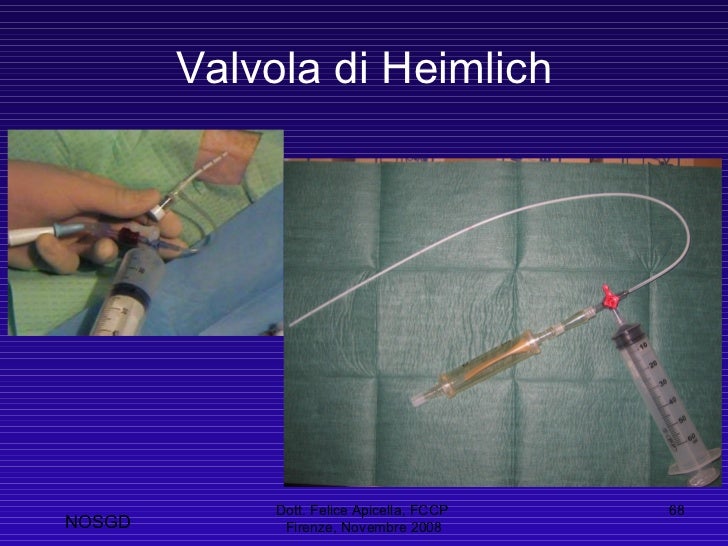 Heimlich e la valvola