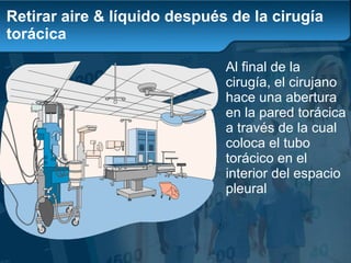 Retirar aire & líquido después de la cirugía torácica A l final de la cirugía, el cirujano hace una abertura en la pared torácica a través de la cual coloca el tubo torácico en el interior del espacio pleural 
