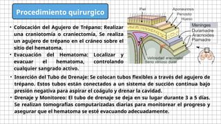De que trata la cirugía del drenaje epidural .pptx
