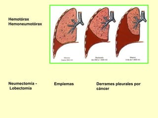 Hemotórax Hemoneumotórax   Neumectomía - Lobectomía   Empiemas  Derrames pleurales por  cáncer 