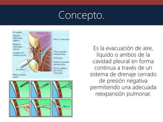Es la evacuación de aire,
líquido o ambos de la
cavidad pleural en forma
continua a través de un
sistema de drenaje cerrado
de presión negativa
permitiendo una adecuada
reexpansión pulmonar.
Concepto.
 