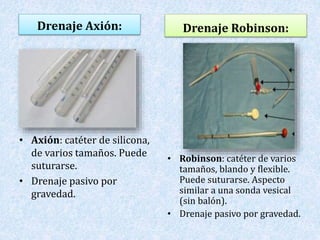 Drenaje Axión: 
• Axión: catéter de silicona, 
de varios tamaños. Puede 
suturarse. 
• Drenaje pasivo por 
gravedad. 
Drenaje Robinson: 
• Robinson: catéter de varios 
tamaños, blando y flexible. 
Puede suturarse. Aspecto 
similar a una sonda vesical 
(sin balón). 
• Drenaje pasivo por gravedad. 
 