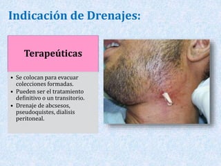 Indicación de Drenajes: 
Terapeúticas 
• Se colocan para evacuar 
colecciones formadas. 
• Pueden ser el tratamiento 
definitivo o un transitorio. 
• Drenaje de abcsesos, 
pseudoquistes, dialisis 
peritoneal. 
 