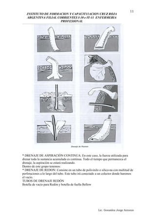 INSTITUTO DE FORMACION Y CAPACIT11ACION CRUZ ROJA
ARGENTINA FILIAL CORRIENTES I-30 e IT-11 ENFERMERIA
PROFESIONAL
* DRENAJE DE ASPIRACIÓN CONTINUA: En este caso, la fuerza utilizada para
drenar toda la sustancia acumulada es continua. Todo el tiempo que permanezca el
drenaje, la aspiración se estará realizando.
Dentro de este grupo tenemos:
* DRENAJE DE REDON: Consiste en un tubo de polivinilo o silico-na con multitud de
perforaciones a lo largo del tubo. Este tubo irá conectado a un colector donde haremos
el vacío.
TUBOS DE DRENAJE REDÓN
Botella de vacío para Redón y botella de fuella Bellow
Lic. González Jorge Antonio
11
 