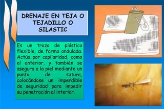DRENAJE EN TEJA O
TEJADILLO O
SILASTIC
Es un trozo de plástico
flexible, de forma ondulada.
Actúa por capilaridad, como
el anterior, y también se
asegura a la piel mediante un
punto de sutura,
colocándose un imperdible
de seguridad para impedir
su penetración al interior.
 
