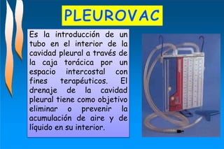 Es la introducción de un
tubo en el interior de la
cavidad pleural a través de
la caja torácica por un
espacio intercostal con
fines terapéuticos. El
drenaje de la cavidad
pleural tiene como objetivo
eliminar o prevenir la
acumulación de aire y de
líquido en su interior.
 