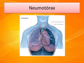 Neumotórax
 