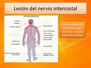 Lesión del nervio intercostal
Cordón conductor
de la trasmisión
nerviosa, situado
entre las costillas
 