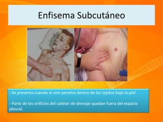 Enfisema Subcutáneo
- Se presenta cuando el aire penetra dentro de los tejidos bajo la piel
- Parte de los orificios del catéter de drenaje quedan fuera del espacio
pleural.
 