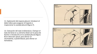 11. Exploración del espacio pleural. Introducir el
dedo índice para asegurar el trayecto e
inspeccionar la cavidad pleural (figura 7).
12. Colocación del tubo endotorácico. Clampar el
tubo de tórax en su extremo distal con la pinza de
Kocher e introducirlo en la cavidad pleural (figura
8) en dirección apical, para drenar un
neumotórax, o posterobasal, para drenar un
hemotórax.
 