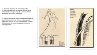 13. Conexión al sistema de drenaje (figura 9).
La colocación adecuada del tubo se constata por la
obtención de burbujeo o líquido y por la oscilación
del sello de agua con la respiración.
14. Fijación del tubo de tórax. Una vez comprobado el
buen funcionamiento del sistema se procederá a
asegurar la posición del tubo con seda del n° 0. Dejar
dado un punto de colchonero para la retirada del
tubo (figura 10).
 