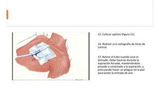 15. Colocar apósito (figura 11).
16. Realizar una radiografía de tórax de
control.
17. Retirar el tubo cuando cese el
drenado. Debe hacerse durante la
espiración forzada, manteniéndolo
pinzado o conectado a la aspiración, y
procurando hacer un pliegue en la piel
para evitar la entrada de aire.
 