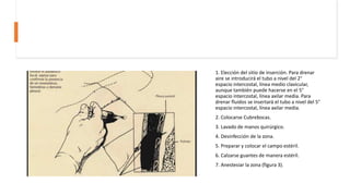 1. Elección del sitio de inserción. Para drenar
aire se introducirá el tubo a nivel del 2°
espacio intercostal, línea medio clavicular,
aunque también puede hacerse en el 5°
espacio intercostal, línea axilar media. Para
drenar fluidos se insertará el tubo a nivel del 5°
espacio intercostal, línea axilar media.
2. Colocarse Cubrebocas.
3. Lavado de manos quirúrgico.
4. Desinfección de la zona.
5. Preparar y colocar el campo estéril.
6. Calzarse guantes de manera estéril.
7. Anestesiar la zona (figura 3).
 