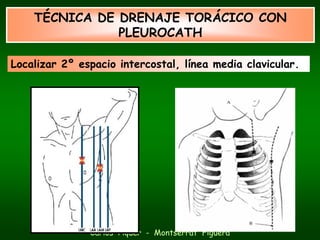 TÉCNICA DE DRENAJE TORÁCICO CON
               PLEUROCATH

Localizar 2º espacio intercostal, línea media clavicular.




               Carlos Piquer - Montserrat Figuera
 