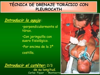 TÉCNICA DE DRENAJE TORÁCICO CON
             PLEUROCATH

Introducir la aguja :
         •perpendicularmente al
         tórax.
         •Con jeringuilla con
         suero fisiológico.
         •Por encima de la 3ª
         costilla.


Introducir el catéter: 2/3
                 de su longitud.
             Carlos Piquer - Montserrat Figuera
 