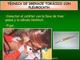 TÉCNICA DE DRENAJE TORÁCICO CON
            PLEUROCATH

•Conectar el catéter con la llave de tres
pasos y la válvula Heimlich.
•Fijar.




            Carlos Piquer - Montserrat Figuera
 