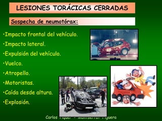 LESIONES TORÁCICAS CERRADAS

   Sospecha de neumotórax:

•Impacto frontal del vehículo.
•Impacto lateral.
•Expulsión del vehículo.
•Vuelco.
•Atropello.
•Motoristas.
•Caída desde altura.
•Explosión.

                    Carlos Piquer - Montserrat Figuera
 