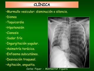 CLÍNICA
•Murmullo vesicular: disminución o silencio.
•Disnea
•Taquicardia
•Hipotensión
•Cianosis
•Sudor frío
•Ingurgitación yugular.
•Asimetría torácica.
•Enfisema subcutáneo.
•Desviación traqueal.
•Agitación, angustia.
               Carlos Piquer - Montserrat Figuera
 
