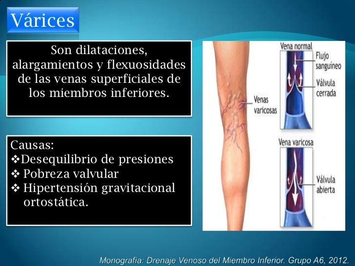 La várice varicosa de los genitales